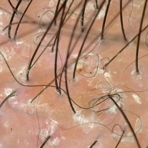 Tricologista em Vitória Exame de tricoscopia